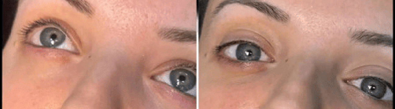 Dermal Fillers